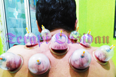 Does Wet Cupping Remove Toxins?